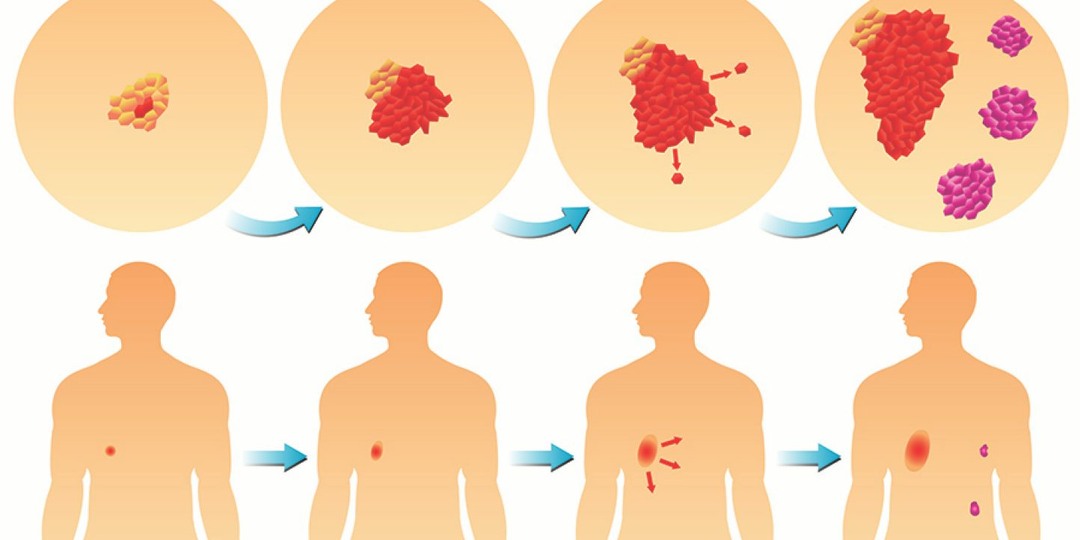Метастазы: как понять, что опухоль распространилась