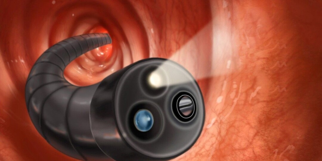 Колоноскопия. Что, как и когда нужно делать, если вы не хотите пропустить беду