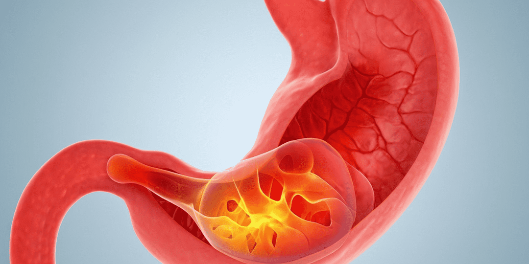 Изжога: не просто неприятность, а сигнал бедствия изнутри