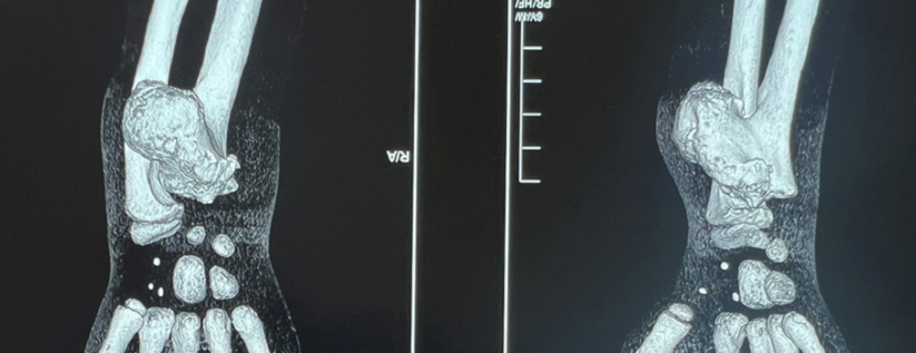 Опухоль по размеру сравнима с объёмом предплечья ребёнка