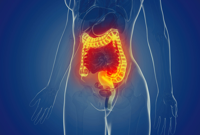 Почему хроническое воспаление кишечника может перерасти в рак толстой кишки