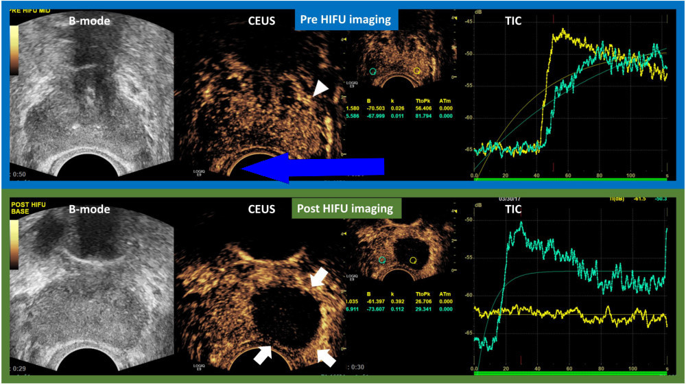    Цветовая слепота может снизить шансы на выживание при раке мочевого пузыря ученые предполагают