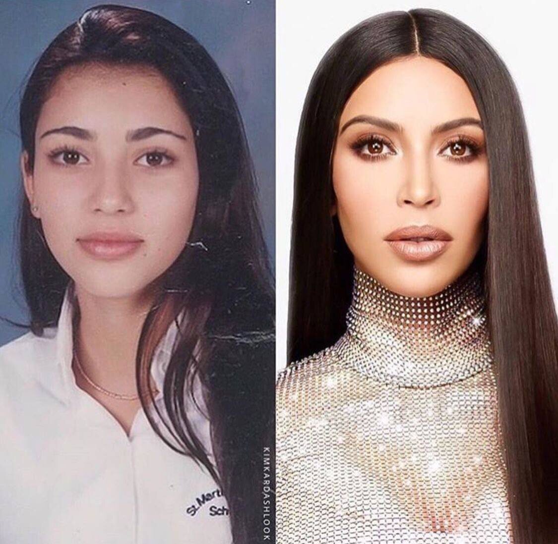 Если сравнить её фотографии до 2015 года и после — становится очевидно:
внешние хвосты бровей стали выше, лоб — более гладким, а взгляд — «распахнутым», но без эффекта удивления.
Это классический результат эндоскопического Brow Lift, выполненного с ювелирной точностью.
