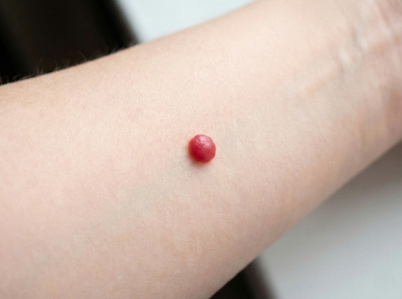 Так выглядит типичная ангиома. Это не пигмент, а скопление расширенных капилляров