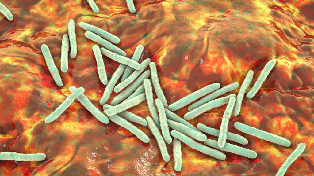 Внелегочные формы туберкулеза