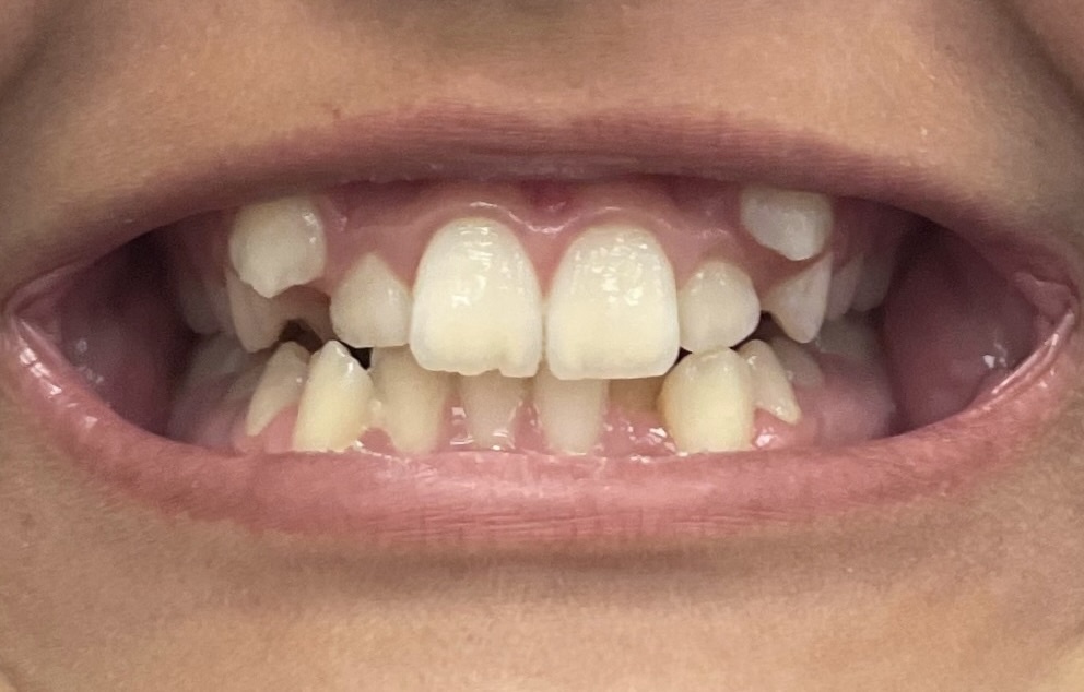 Фото до коррекции прикуса - суправестибулярное положение клыков