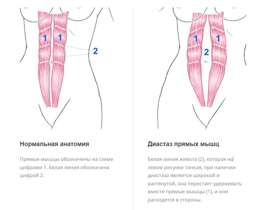 Диастаз прямых мышц живота. Источник: https://eurobariatric.ru/diastase/