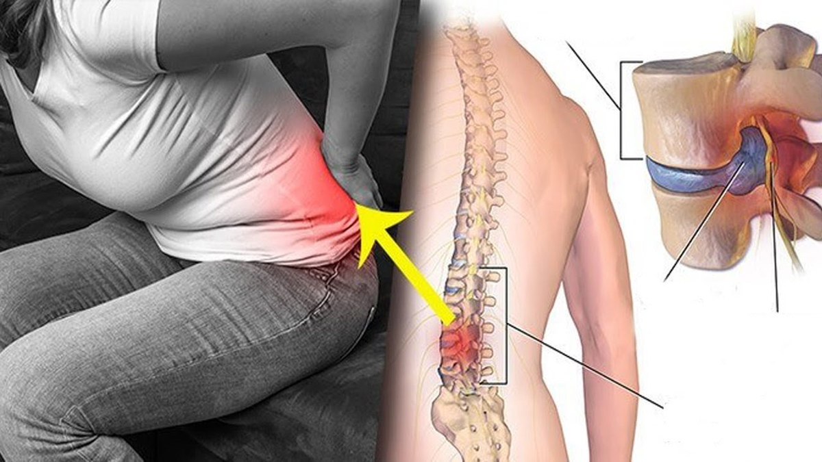 Листез и грыжи: почему у одних болит, а у других — нет