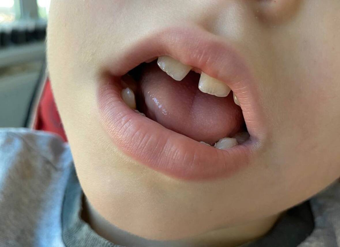 Пример нарушения функций жевательной мускулатуры и языка у ребенка с ДЦП