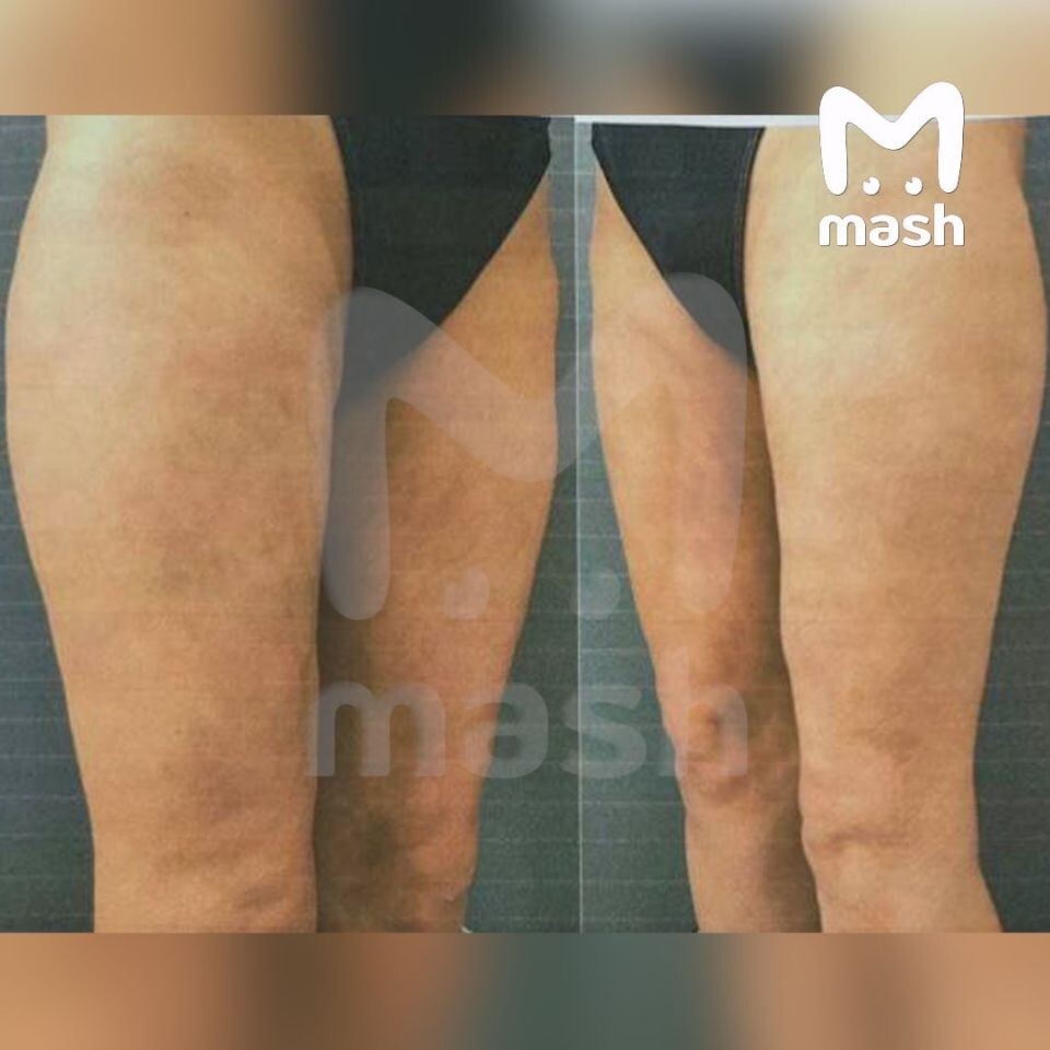    Женщине провели опасную липосакцию в Краснодаре. Источник: t.me/mash