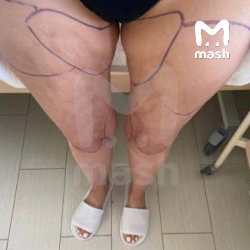    Женщине провели опасную липосакцию в Краснодаре. Источник: t.me/mash