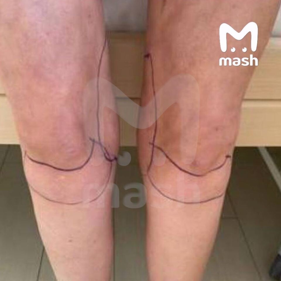    Женщине провели опасную липосакцию в Краснодаре. Источник: t.me/mash