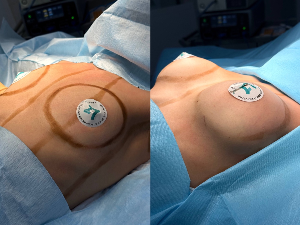 Увеличение груди силиконовыми импоантами подмышечным доступом в исполнении Новоселова Олега Александровича