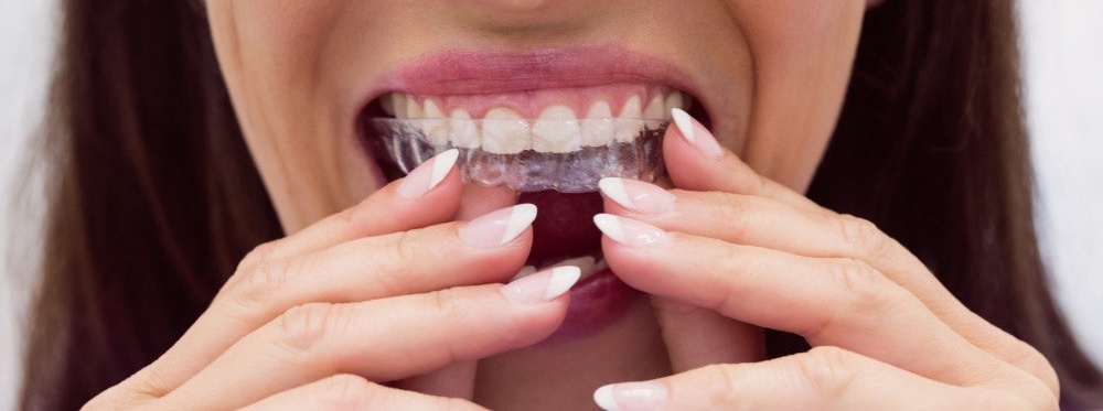 Как работают отбеливающие каппы?