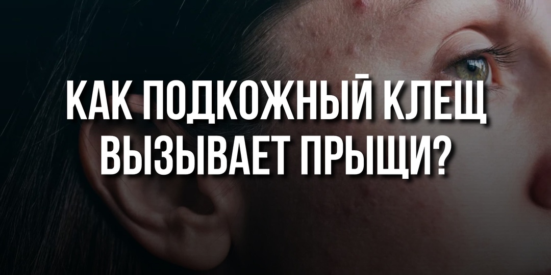 Как подкожный клещ вызывает прыщи?