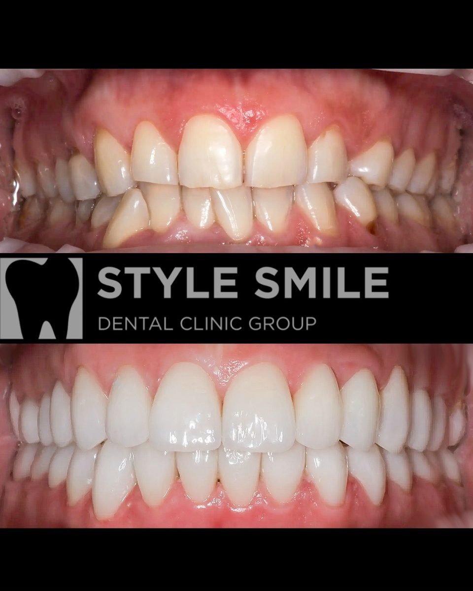 До и после тотальной реконструкции улыбки