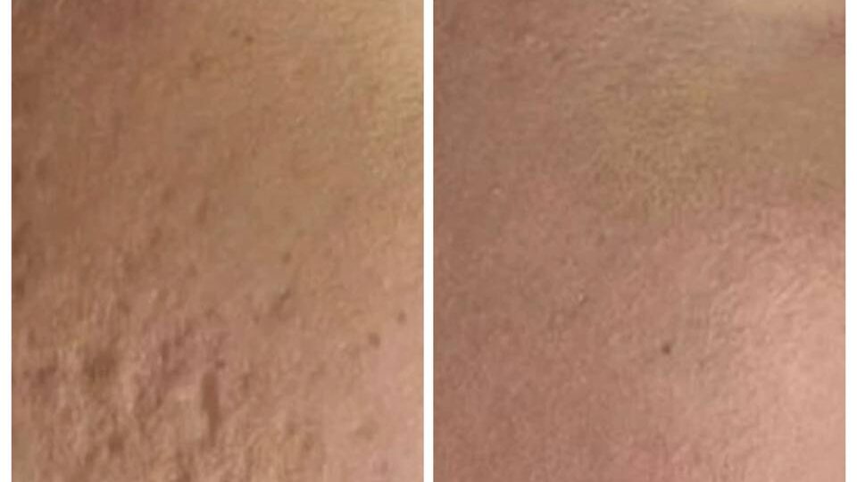 Может ли дермапен убрать рубцы?