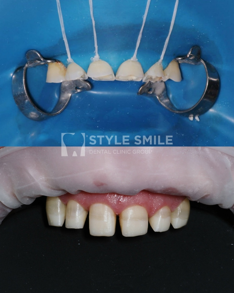 Восстановление высоты зубов с помощью методики Build-up