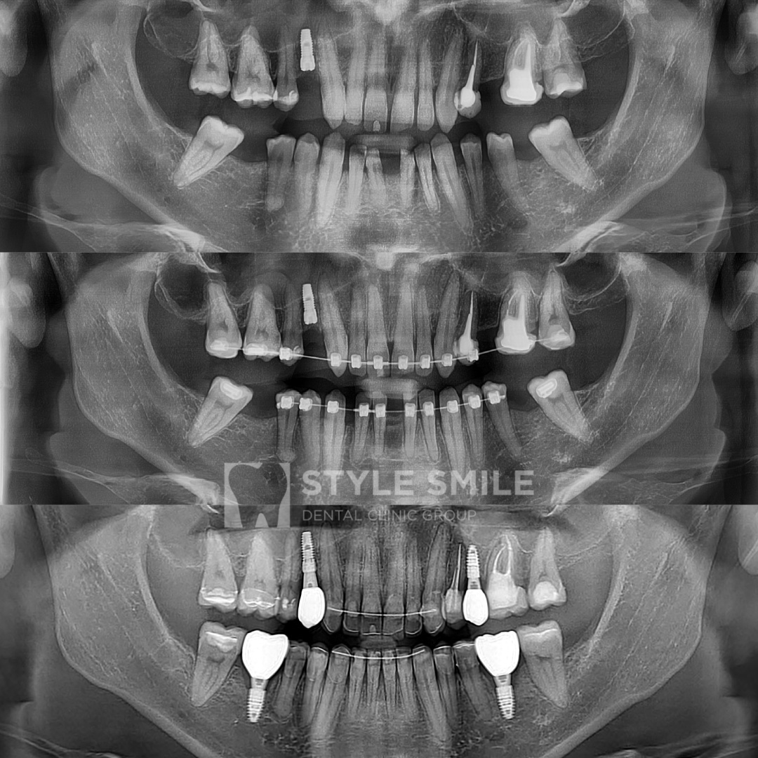 1 - до лечения,
2 - во время лечения,
3 - после окончания лечения
