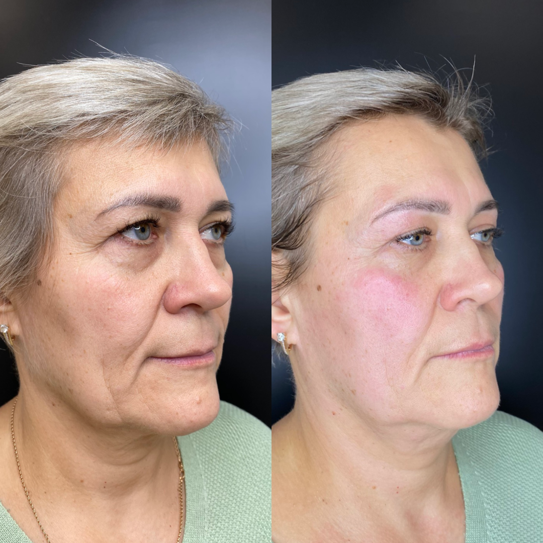 результат сразу после аппаратной процедуры монополярного, безболезеннего RFлифтинга Volnewmer