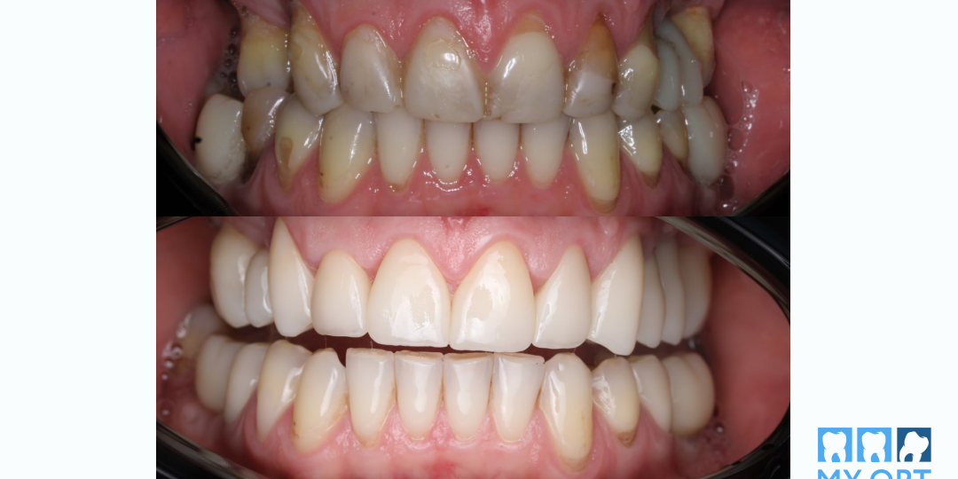 Как мы исправили чужую ошибку с имплантатами Straumann. Сложный клинический случай.