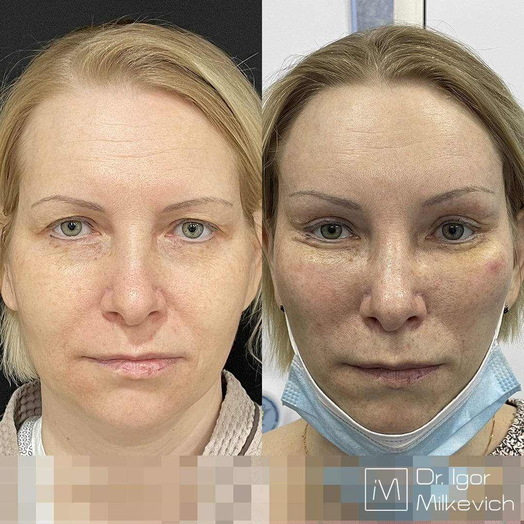 7 день после операции