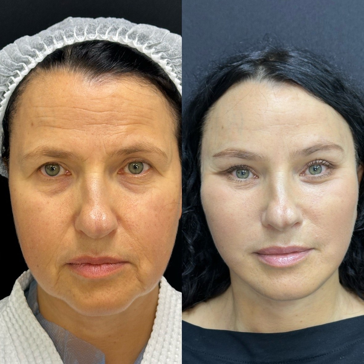 16 дней после операции. Возраст пациентки: 57 лет