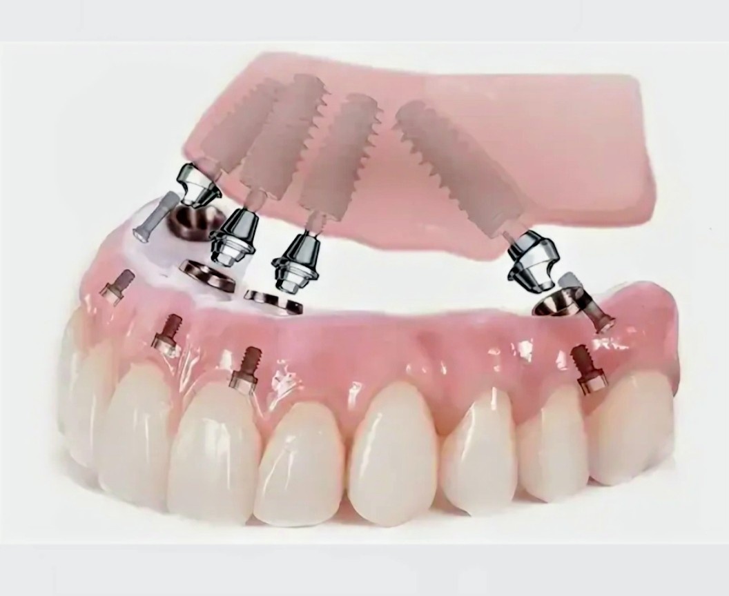 Имплантация All-on-4