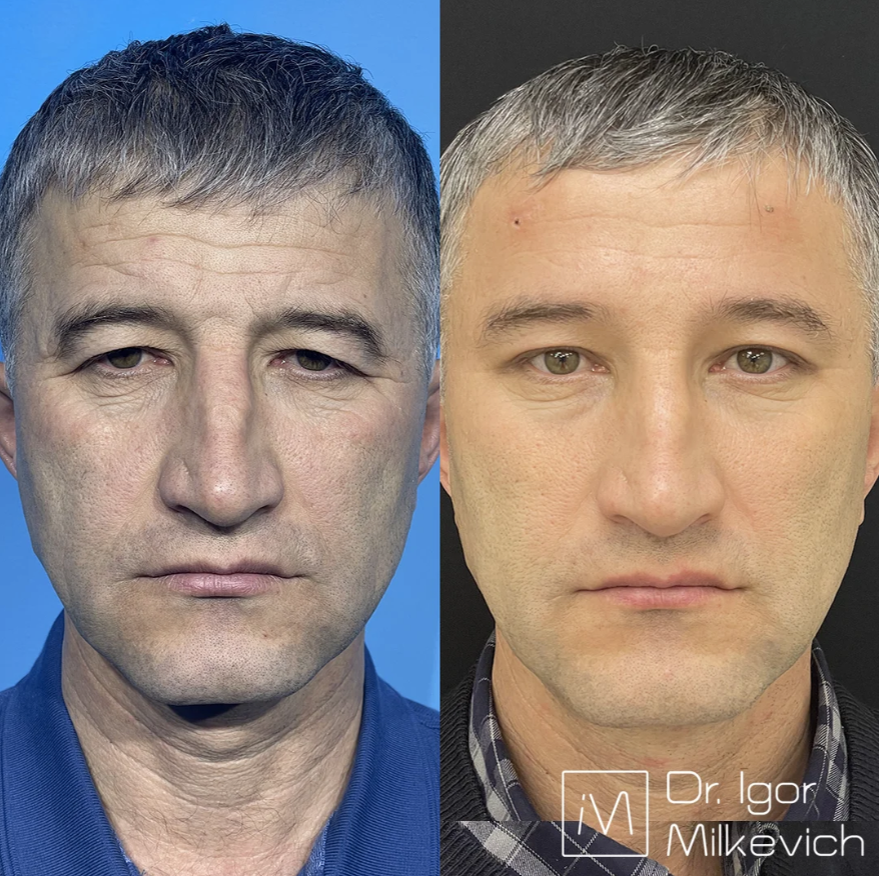 2 недели после эндоскопической подтяжки лба 