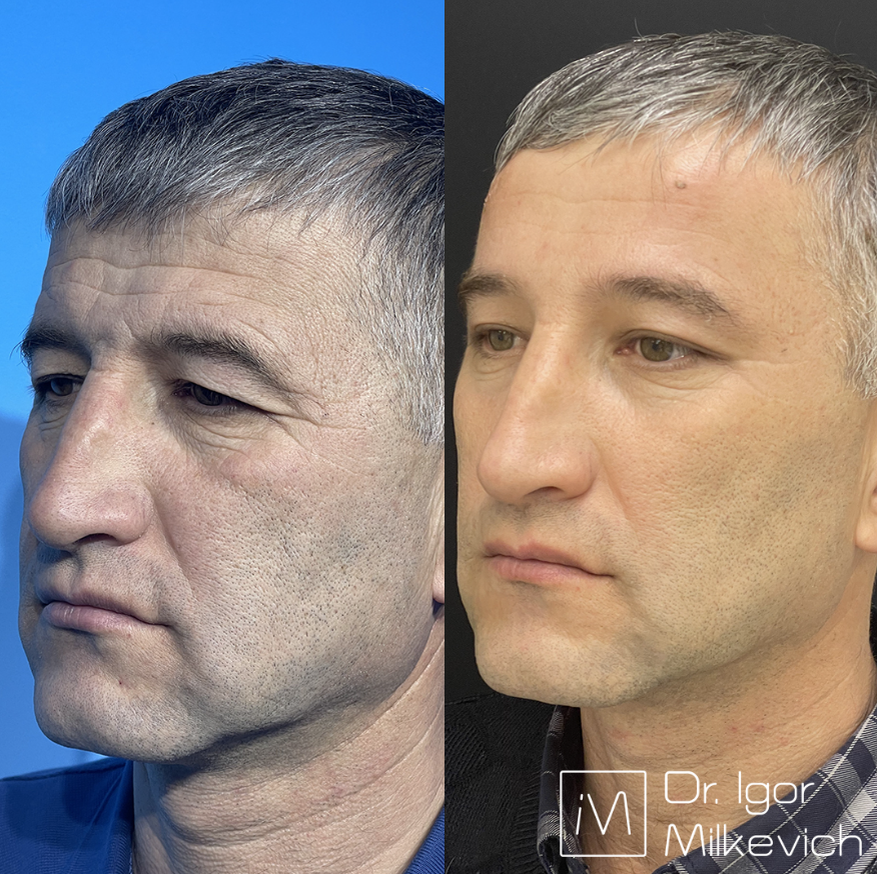 2 недели после подтяжки лба 