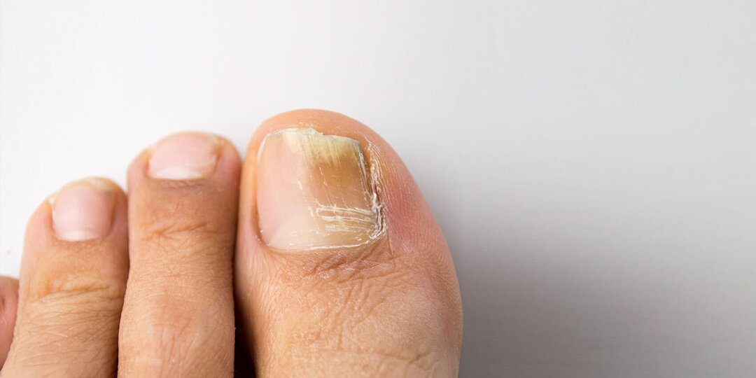 Грибок ногтей: как распознать, вылечить и не позволить ему вернуться
