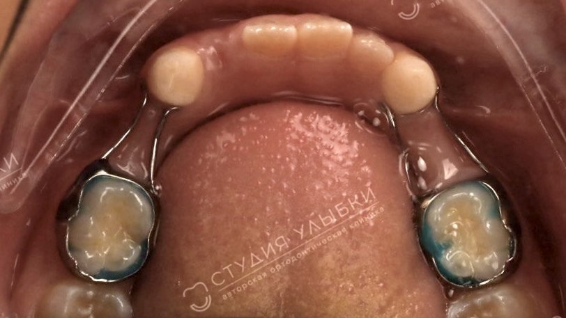 Распорка ортодонтическая