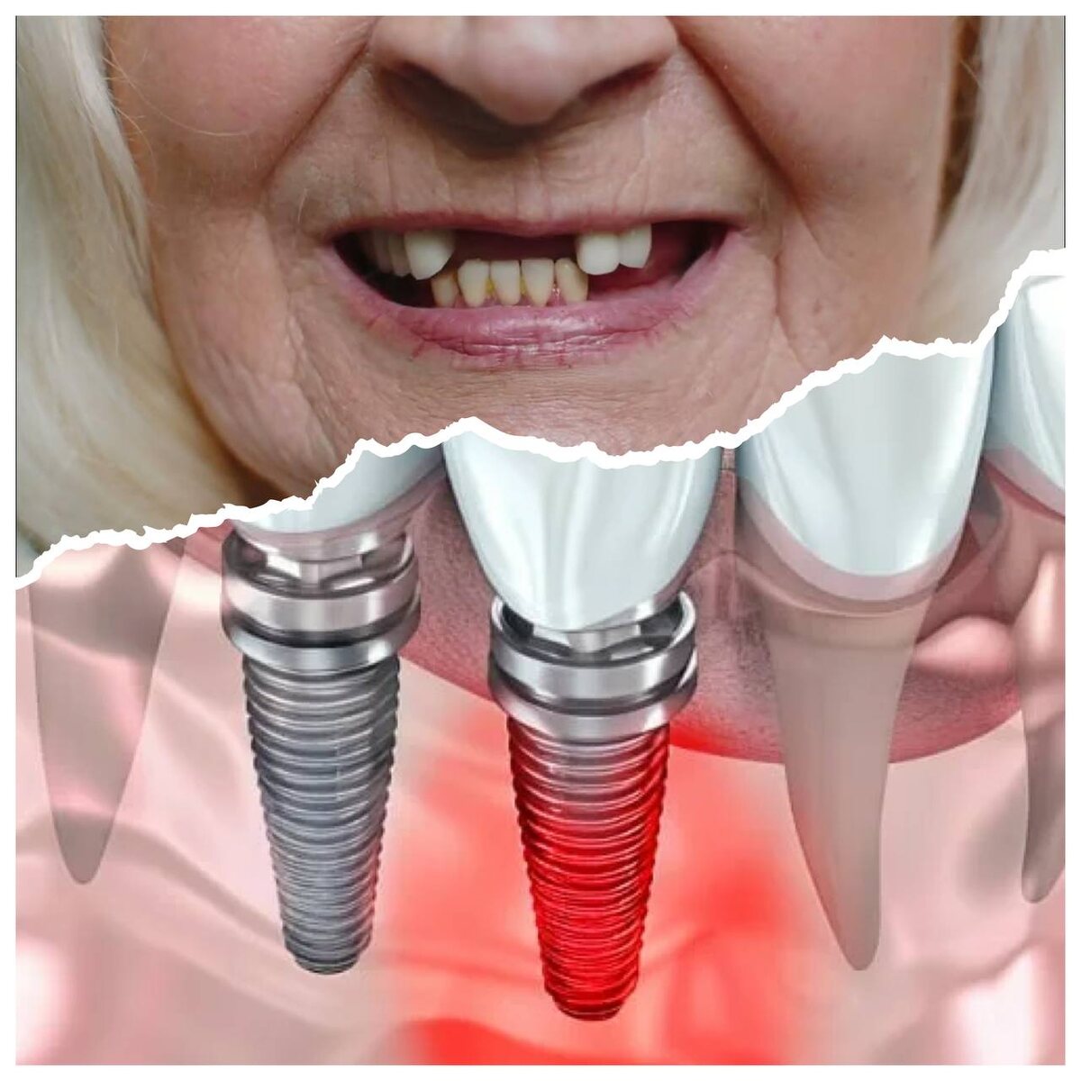 Импланты подходят не всем