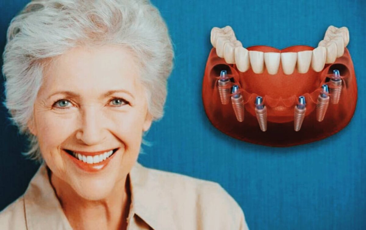 Импланты могут значительно облегчить вам жизнь