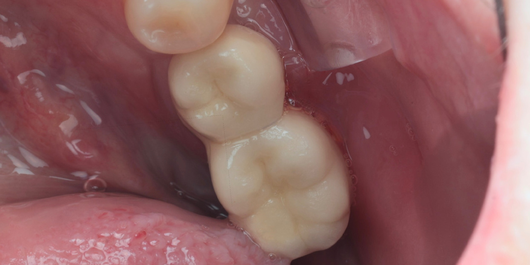 Имплантат простоял более 10 лет - а потом гной, отёк и удаление. Разбираем, почему так бывает и как бывает ещё