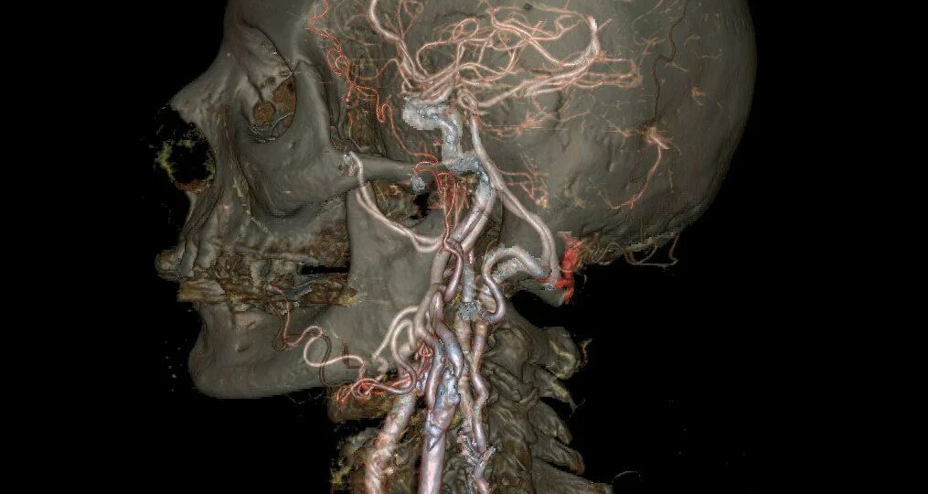 МРТ или КТ сосудов головы и шеи: Как не запутаться в трех соснах и выбрать то, что покажет правду