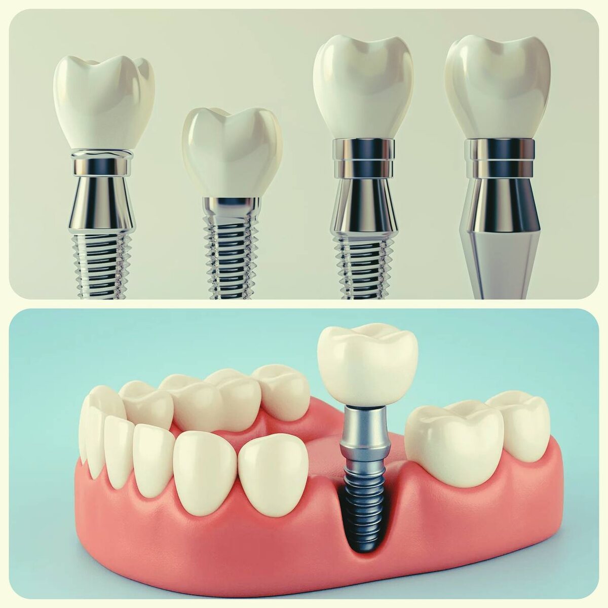 Импланты не так страшны как кажутся