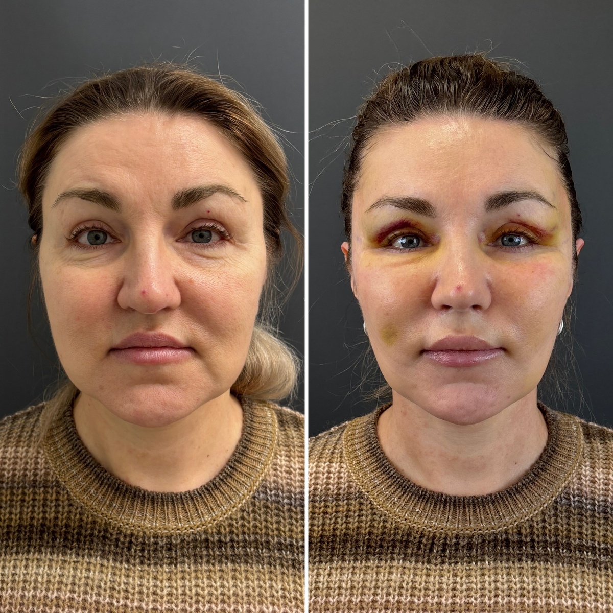 Эндоскопический лифтинг верхних 2/3 лица (слева- до, справа- после). Хирург Остринская Т.В.