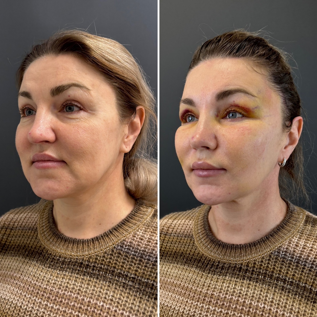 Эндоскопический лифтинг верхних 2/3 лица (слева- до, справа- после). Хирург Остринская Т.В.