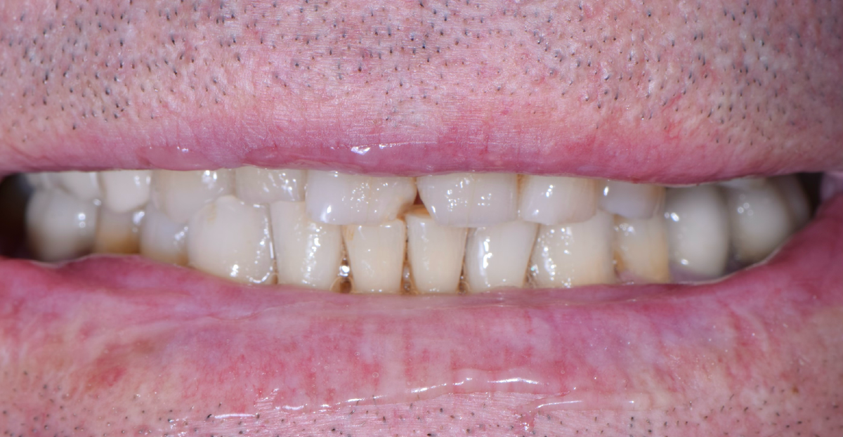 так выглядела улыбка в жизни до лечения 