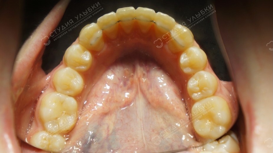 Несъёмный ретейнер