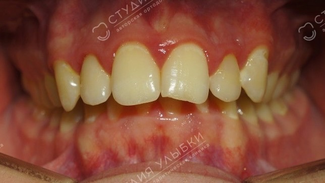 Фотопротокол перед ортодонтическим лечением. Литайте галерею, чтобы увидеть больше фото.