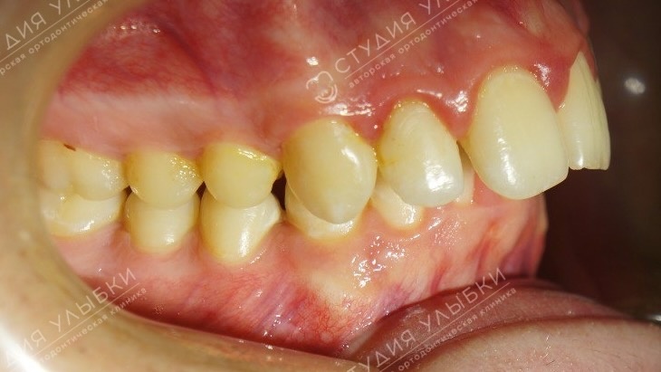 Фотопротокол перед ортодонтическим лечением. Литайте галерею, чтобы увидеть больше фото.