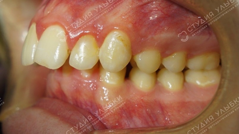 Фотопротокол перед ортодонтическим лечением. Литайте галерею, чтобы увидеть больше фото.