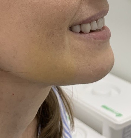 День, когда мне поставили верхние коронки. Отёк спал, только синяки остались 