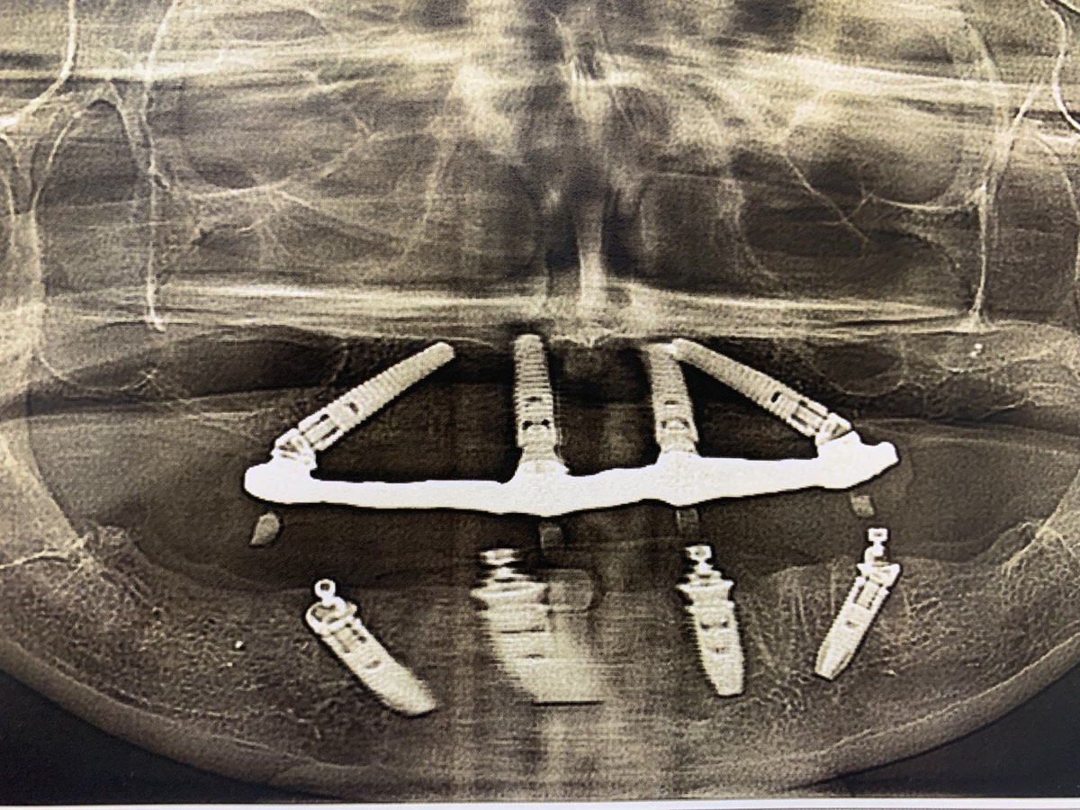Мой снимок челюсти. На эти импланты прикручены коронки. Это и есть мои зубы 