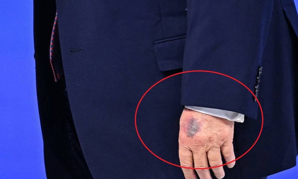    Синяк на руке Трампа, фото: соцсети