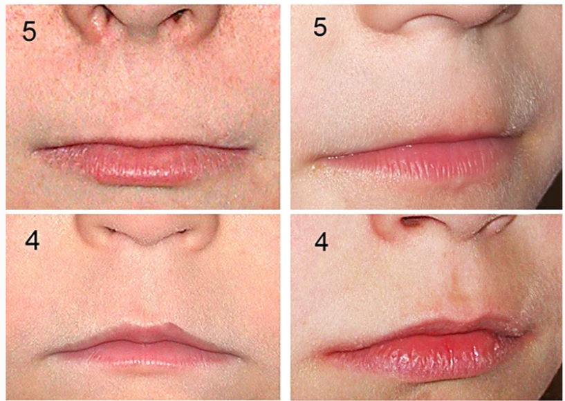 4. и 5. ряды отражают тонкие губы и гладкий фильтрум, характеризующие лицевой фенотип фетального алкогольного синдрома