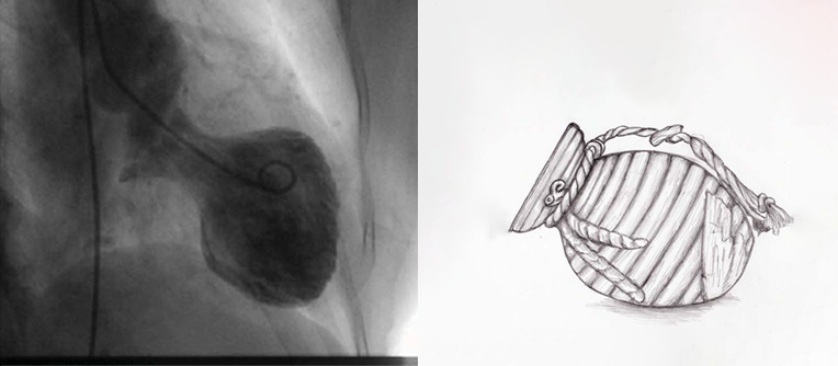 Левый желудочек переполняется кровью и растягивается. Сердце принимает форму японской ловушки для осьминогов.