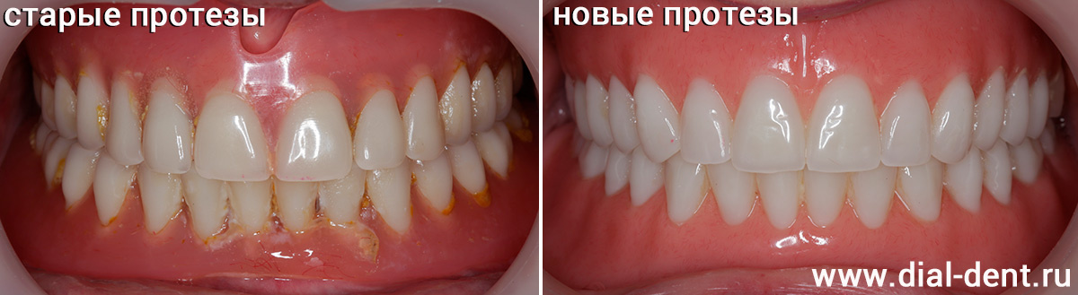 замена полных съемных зубных протезов на обеих челюстях